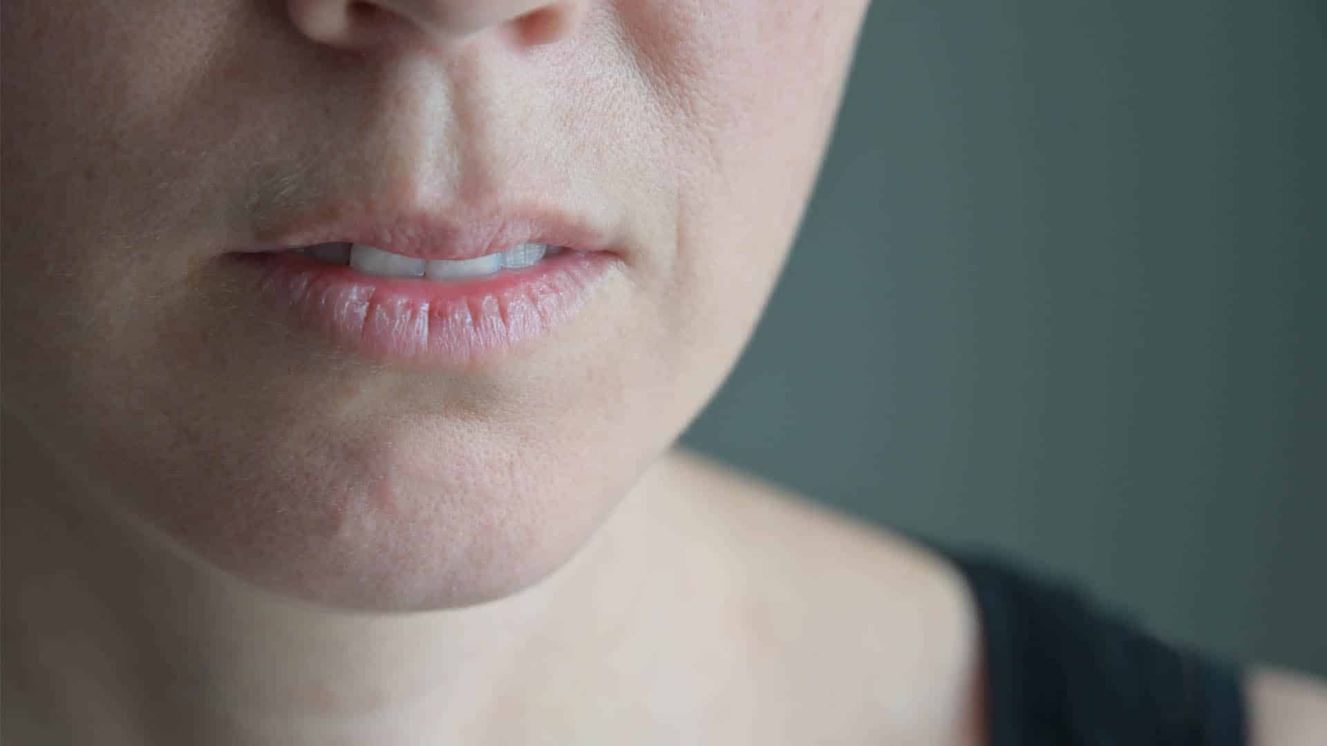 Adult woman suffers from a very dry lips